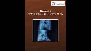 Transforming Pain to Progress: VDRO Success in Perthes Disease