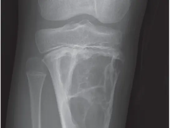 Bone Tumours and Lesions Treatment