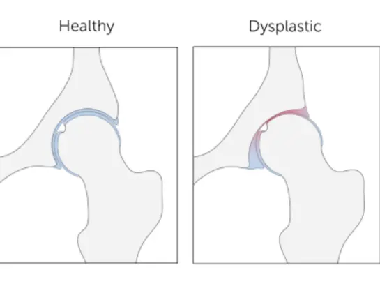 Developmental Dysplasia of the Hip Treatment