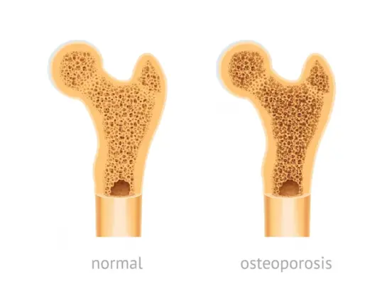 Osteogenesis Imperfecta Treatment
