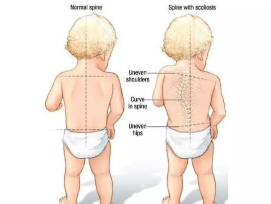 scoliosis-treatment-near-secunderabad